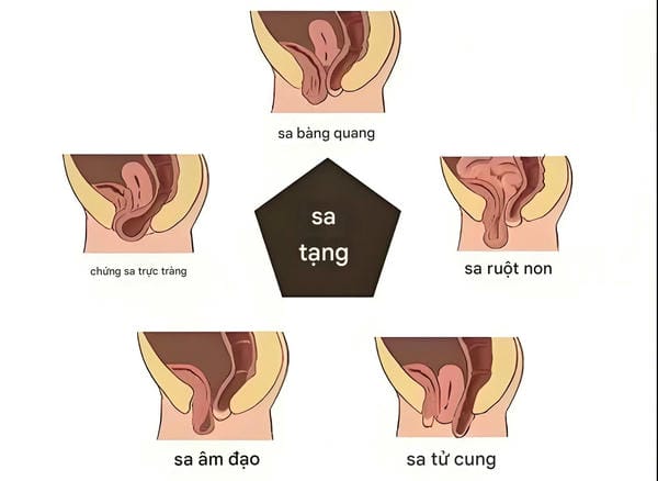 hình ảnh sa tử cung độ 1 4
