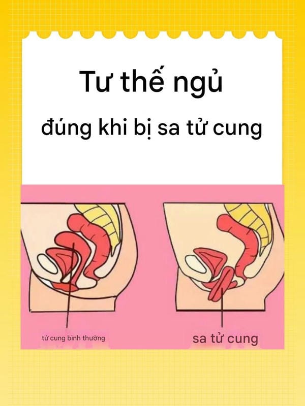 hình ảnh sa tử cung độ 1 8