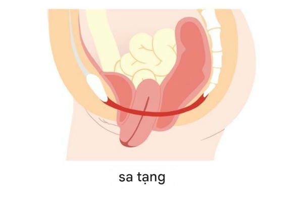 hình ảnh sa tử cung sau sinh