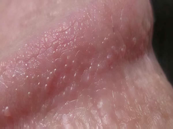 hình ảnh sùi mào gà giai đoạn đầu 1
