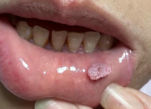 hình ảnh sùi mào gà giai đoạn đầu 13