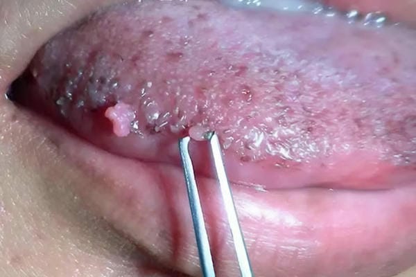 hình ảnh sùi mào gà giai đoạn đầu 17