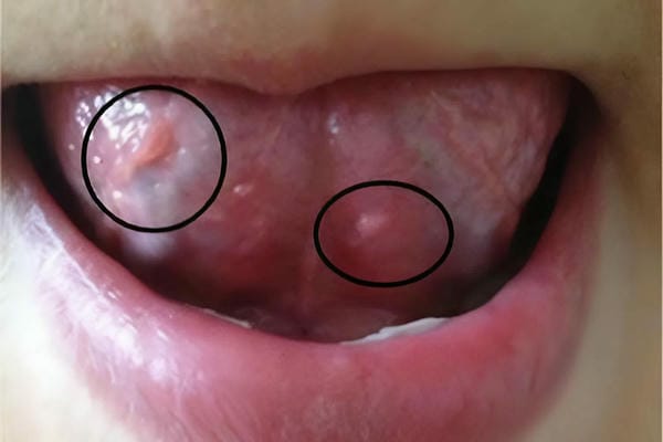 hình ảnh sùi mào gà giai đoạn đầu 19