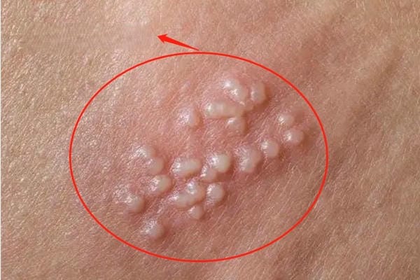 hình ảnh sùi mào gà giai đoạn đầu 2