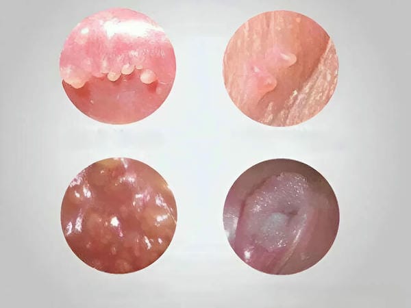 hình ảnh sùi mào gà giai đoạn đầu 20