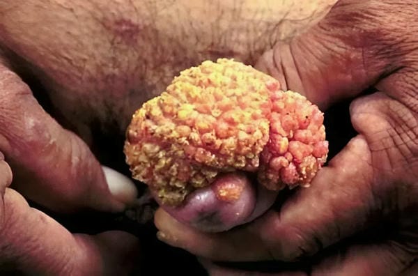 hình ảnh sùi mào gà giai đoạn đầu 25