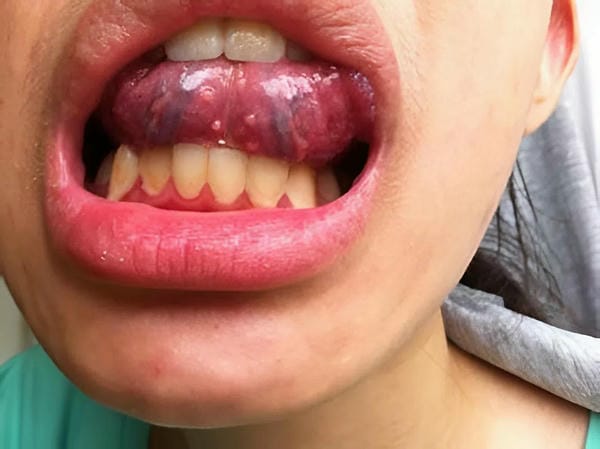 hình ảnh sùi mào gà giai đoạn đầu ở nam