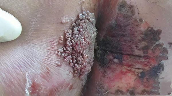 hình ảnh sùi mào gà ở lưỡi giai đoạn đầu