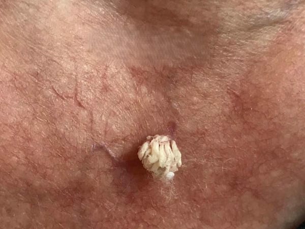 hình ảnh sùi mào gà ở vùng kín nữ giai đoạn đầu