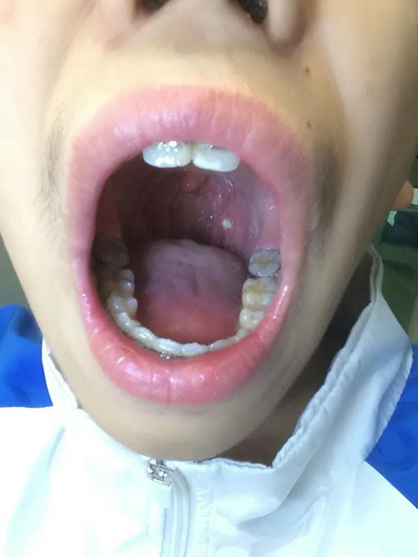 hình ảnh viêm họng hạt trắng 10