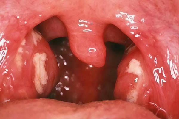 hình ảnh viêm họng hạt trắng 11