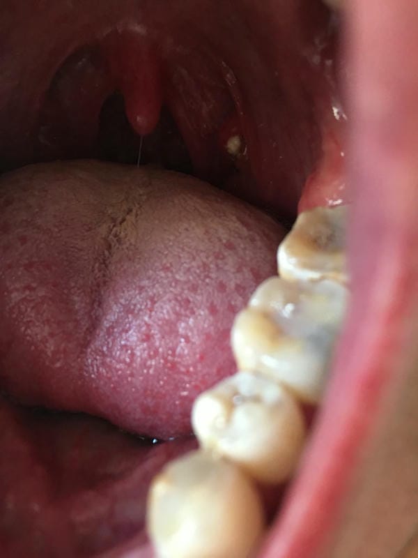 hình ảnh viêm họng hạt trắng 12