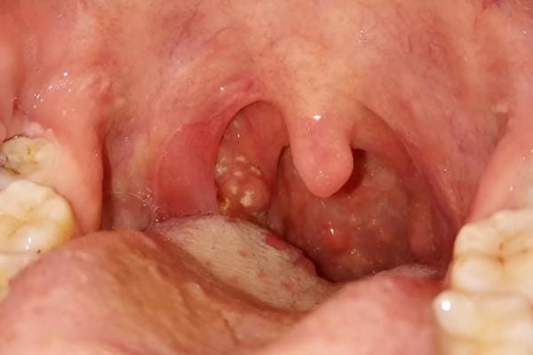 hình ảnh viêm họng hạt trắng 15