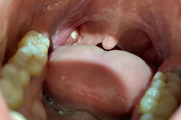 hình ảnh viêm họng hạt trắng 16