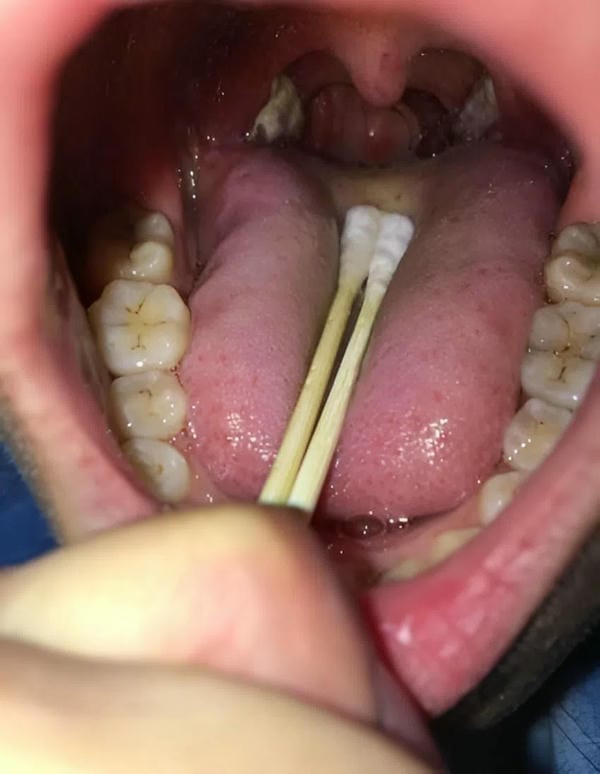 hình ảnh viêm họng hạt trắng 18