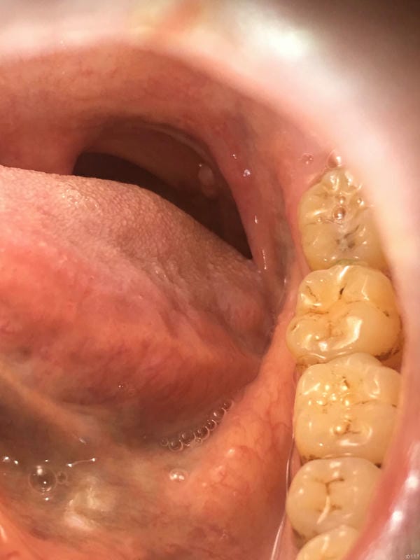 hình ảnh viêm họng hạt trắng 21