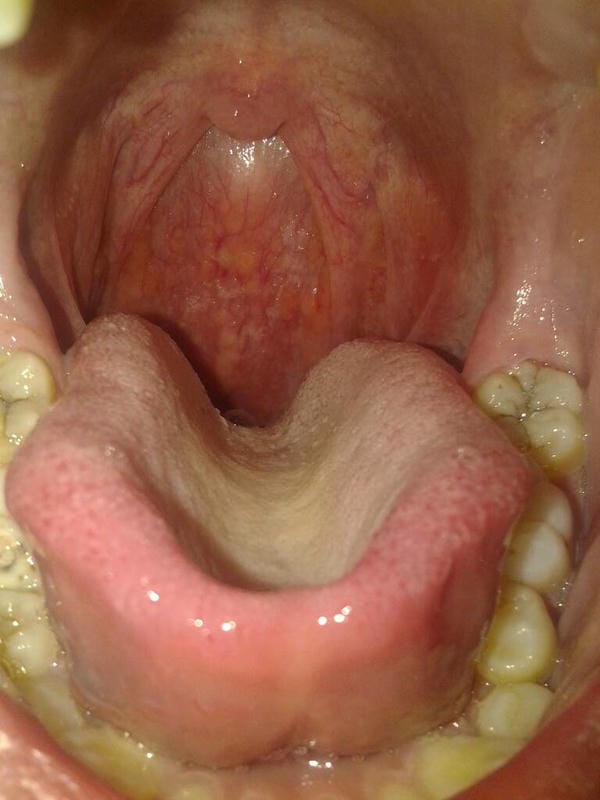 hình ảnh viêm họng hạt trắng 22