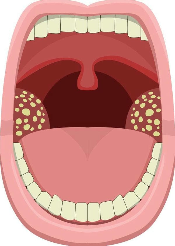 hình ảnh viêm họng hạt trắng 25