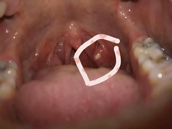 hình ảnh viêm họng hạt trắng 3