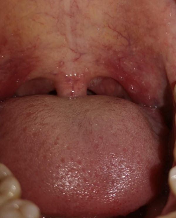 hình ảnh viêm họng hạt trắng 4