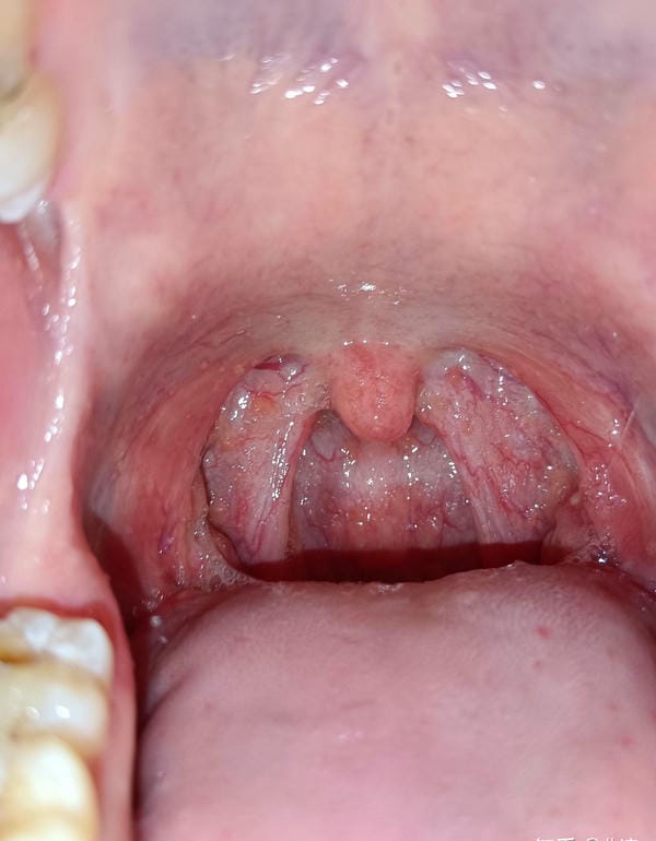 hình ảnh viêm họng hạt trắng 5