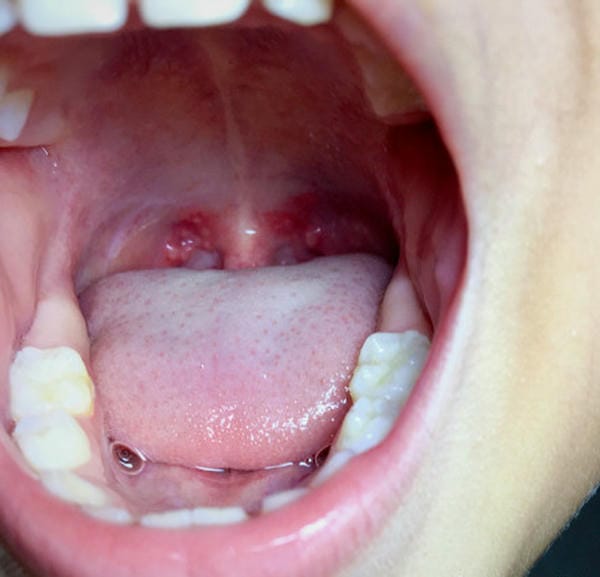 hình ảnh viêm họng hạt trắng 6