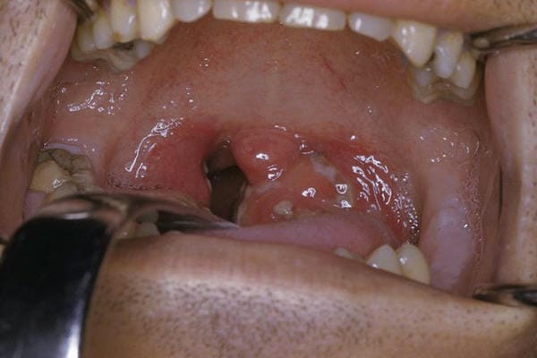 hình ảnh viêm họng hạt trắng 8