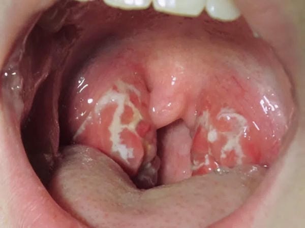hình ảnh viêm họng hạt trắng 9