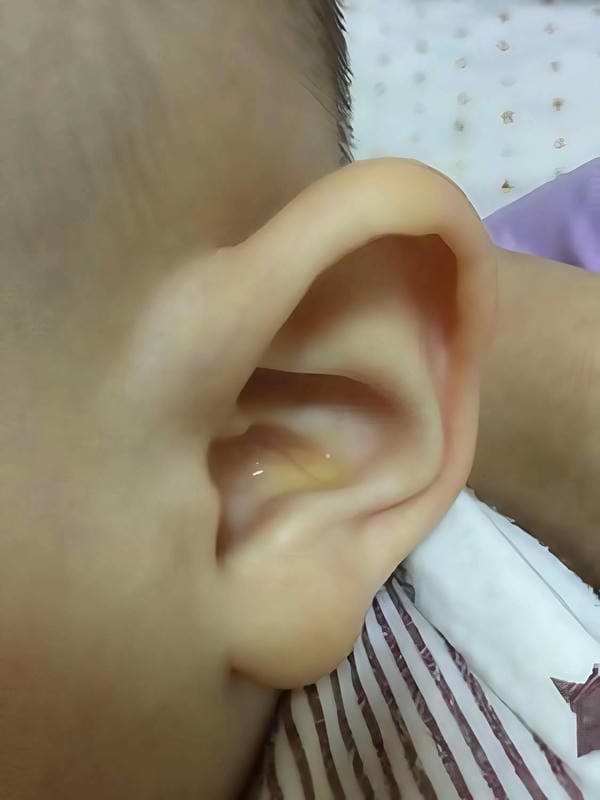 hình ảnh viêm tai giữa ở người lớn 13