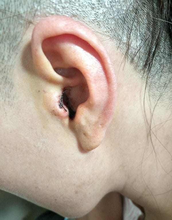 hình ảnh viêm tai giữa ở người lớn 14