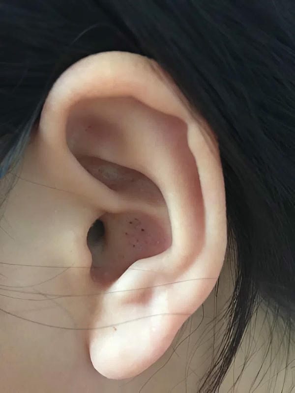 hình ảnh viêm tai giữa ở người lớn 16
