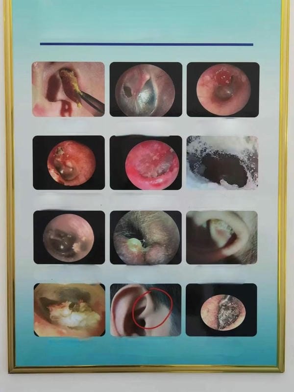 hình ảnh viêm tai giữa ở người lớn 2