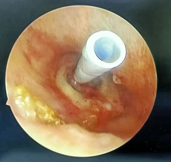 hình ảnh viêm tai giữa ở người lớn 21
