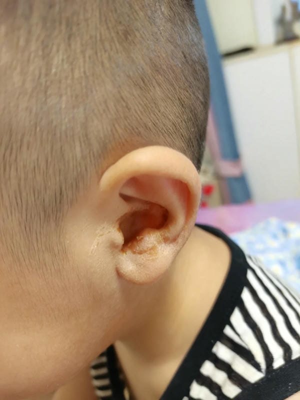 hình ảnh viêm tai giữa ở người lớn 23