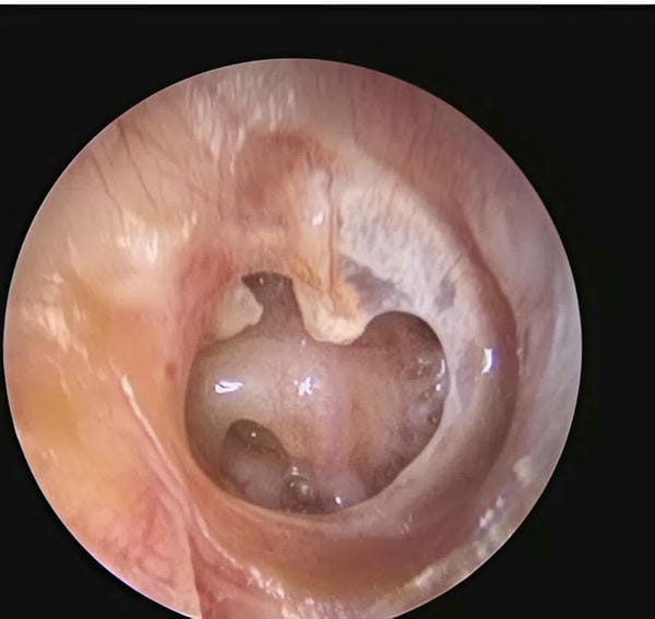 hình ảnh viêm tai giữa ở người lớn 6