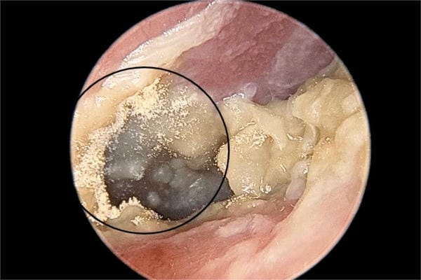 hình ảnh viêm tai giữa ở người lớn 7