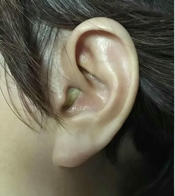 hình ảnh viêm tai giữa ở người lớn 8