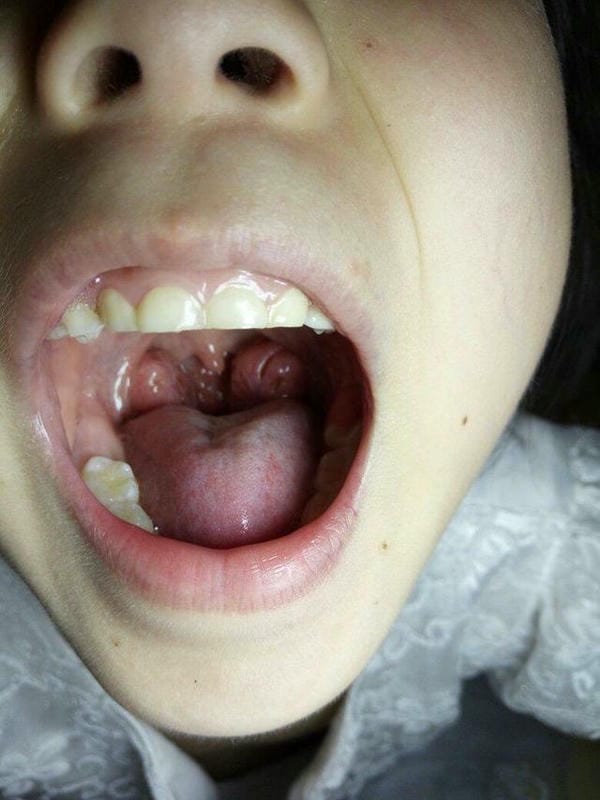 ung thư vòm hình ảnh viêm họng hạt trắng