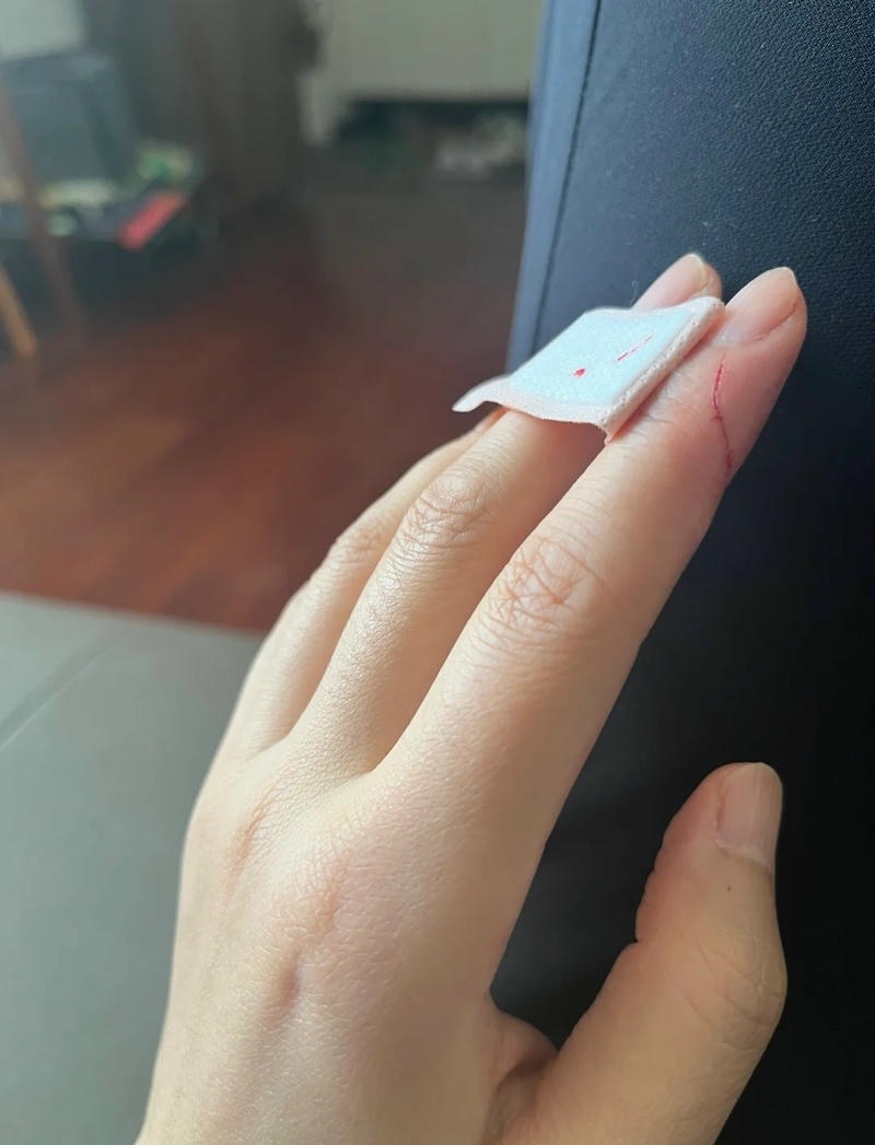 ảnh bị đứt tay bị cắt nhẹ