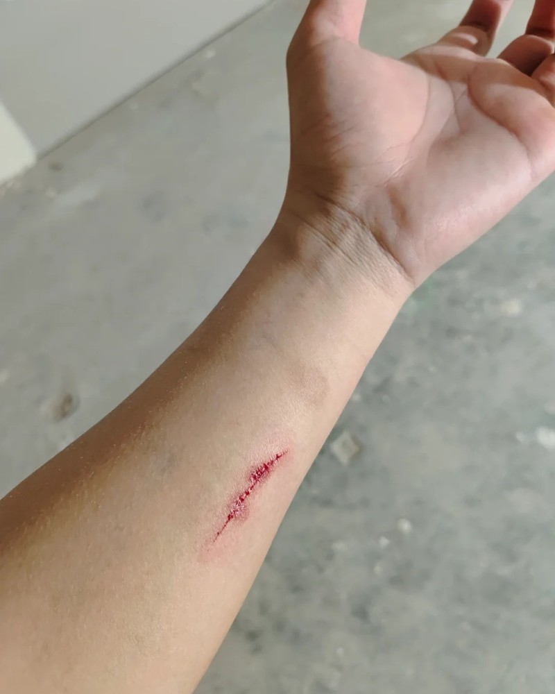 ảnh bị đứt tay 10