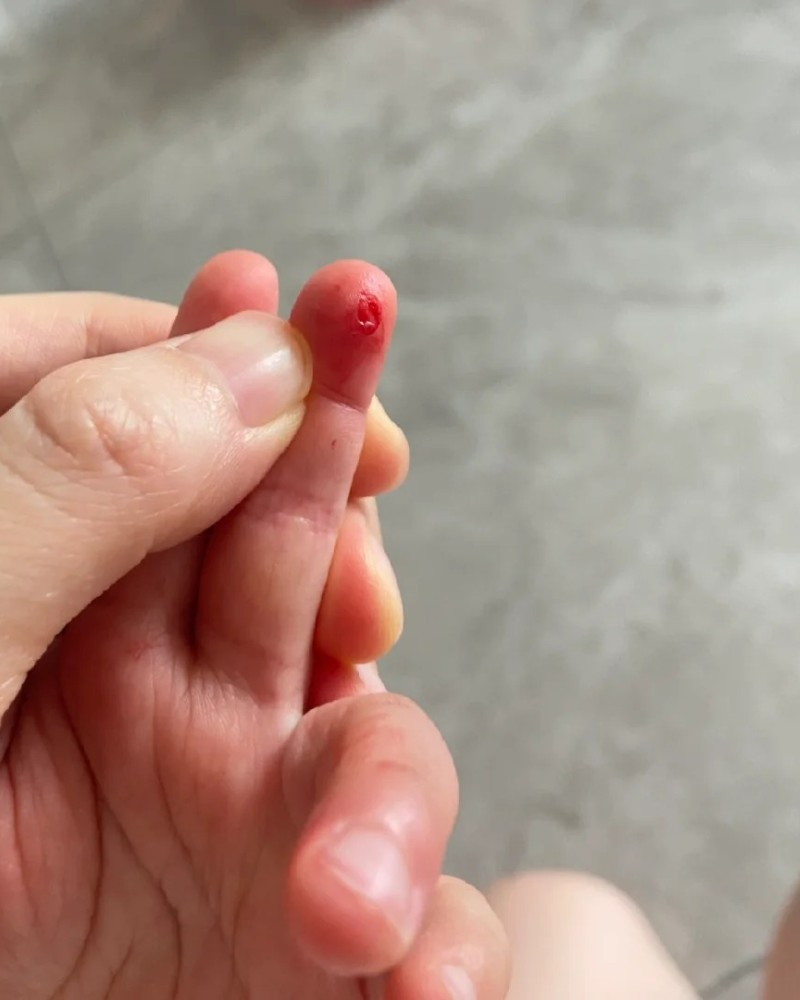 ảnh bị đứt tay 11