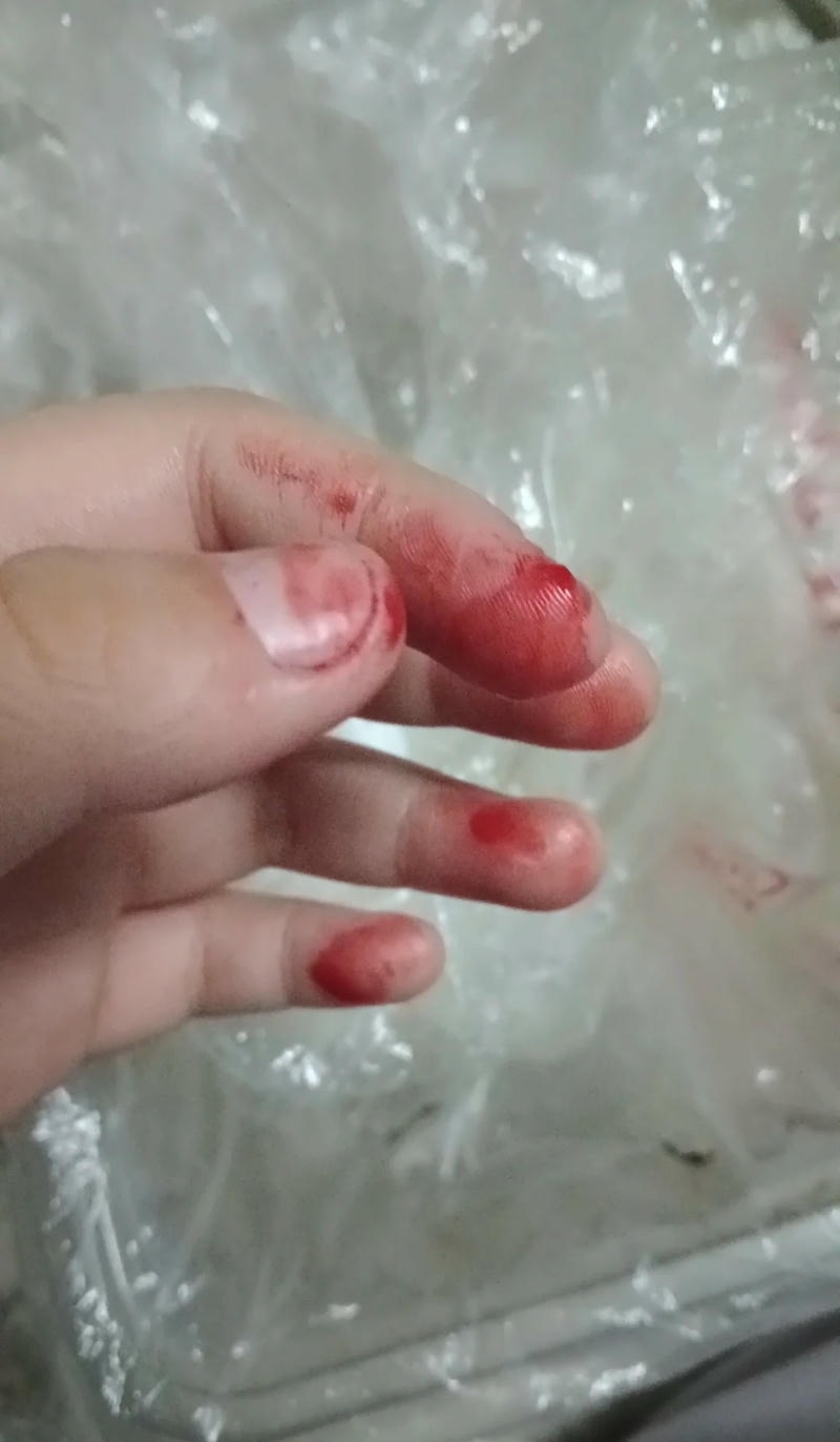 Ngón tay bị chảy máu do cắt phải
