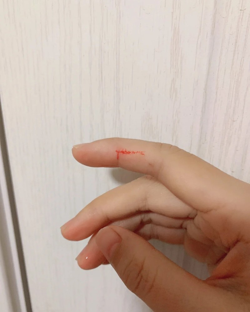 ảnh bị đứt tay 14