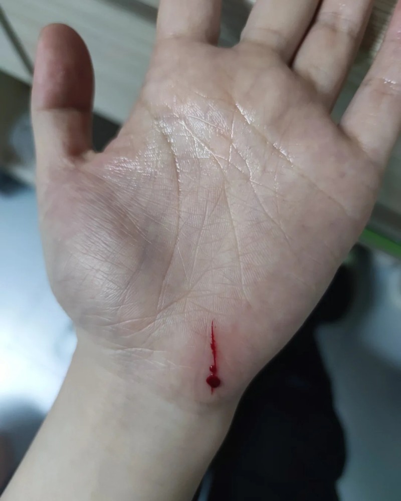 ảnh bị đứt tay 16