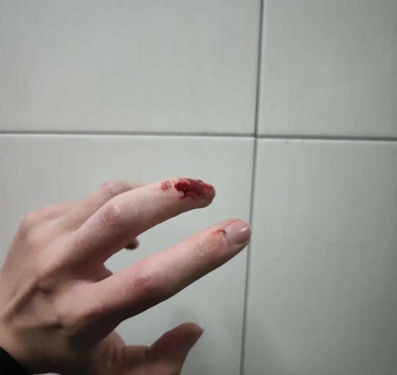 Vết thương hở trên bàn tay