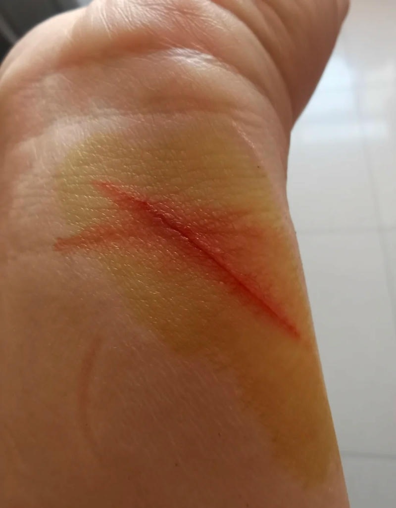 Ngón tay bị trầy xước do vật nhọn
