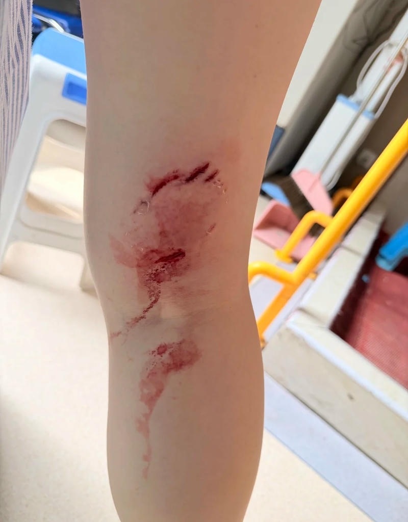 Bàn tay bị tổn thương do tai nạn nhỏ