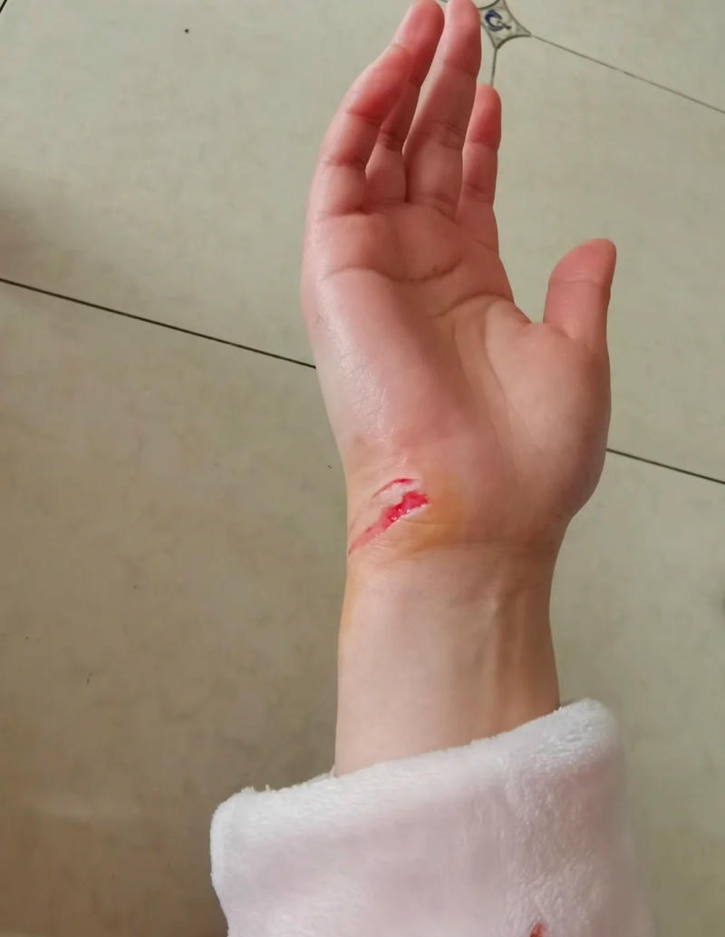 Hình ảnh vết thương cần sát trùng