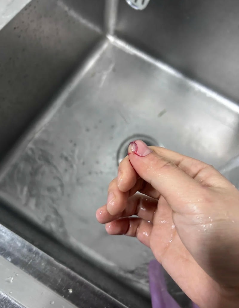 Vết rách da tay mức độ nhẹ