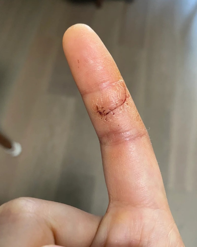 ảnh bị đứt tay 25